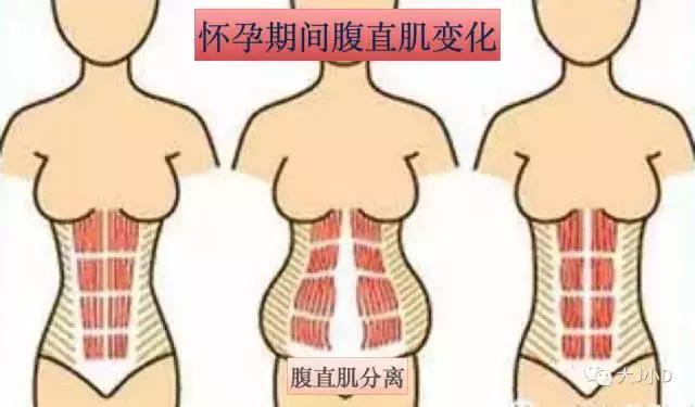 你的腹直肌分離了嗎？