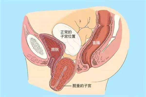 【產(chǎn)后修復(fù)】盆腔臟器脫垂，你有嗎？