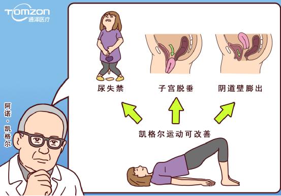 使用凱格爾球還能做盆底治療儀嗎？