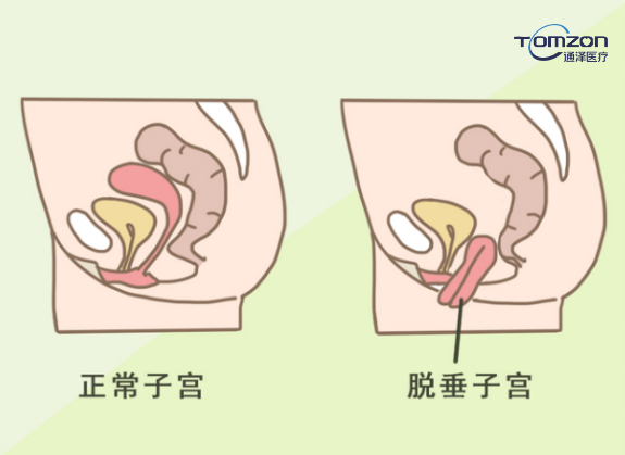 盆底康復(fù)治療儀能夠改善什么樣的情況？